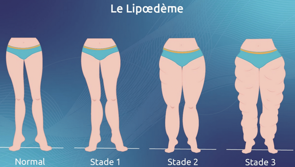Différents stades du lipœdème.